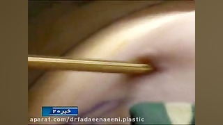 اولین عمل جراحی لیپولیز اینفراسونیک در استان گیلان دکتر علیرضا فدایی نایینی