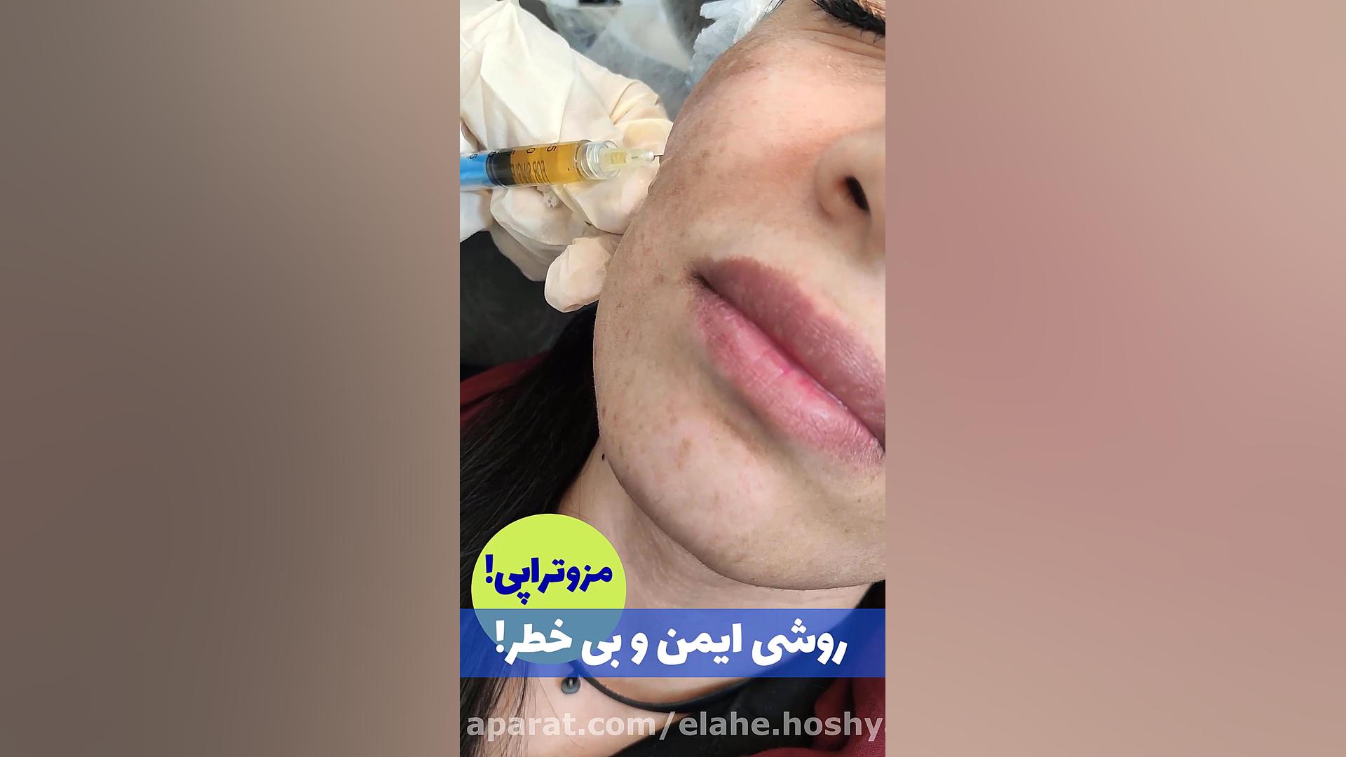 مزوتراپی ضد لک صورت سینتولاژوماب