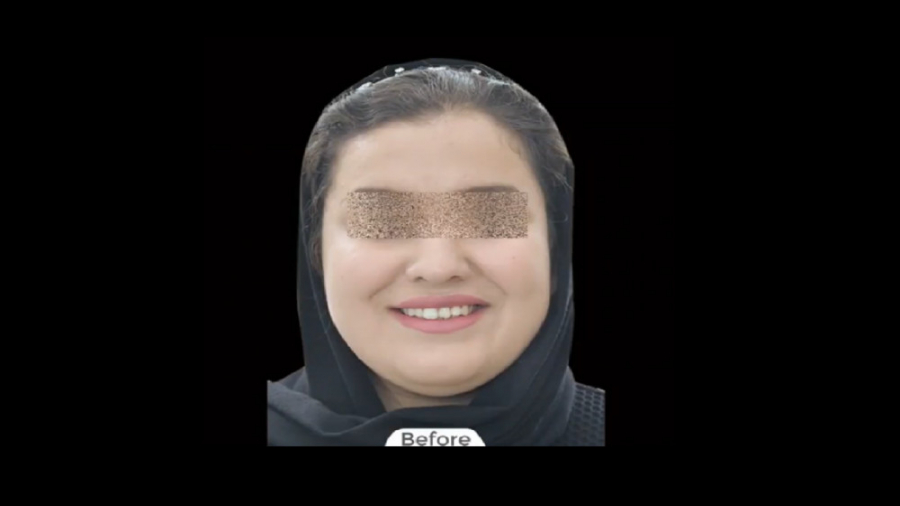 درمان ارتودنسی ثابت با کشیدن یک دندان دائمی دکتر برهمن سبزواری - متخصص ارتودنسی - مشهد