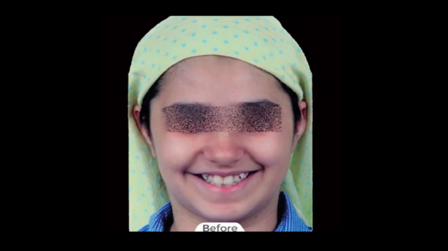 ارتودنسی ثابت با کشیدن سه دندان آسیای کوچک در فک بالا و فک پایین دکتر برهمن سبزواری - متخصص ارتودنسی - مشهد