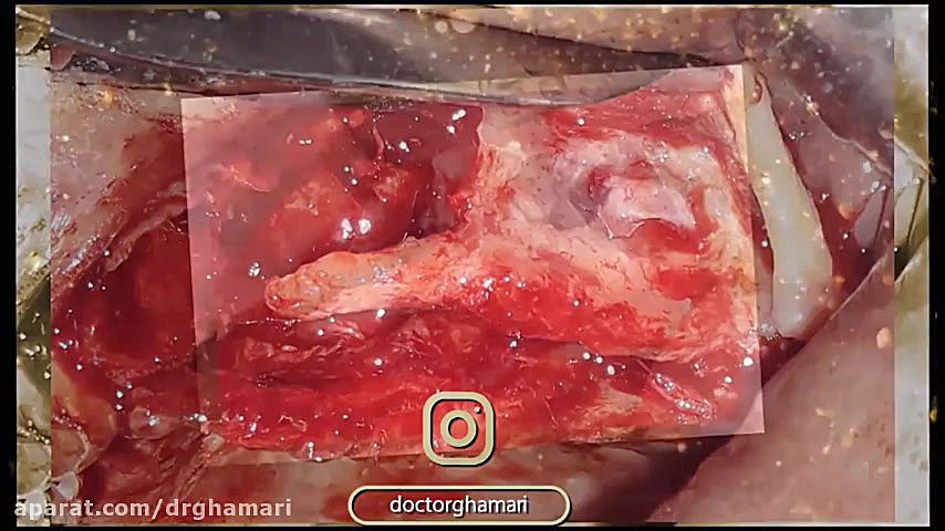 جراحی سینوس لیفت باز همزمان با کاشت دکتر علی قمری - متخصص جراحی لثه و ایمپلنت