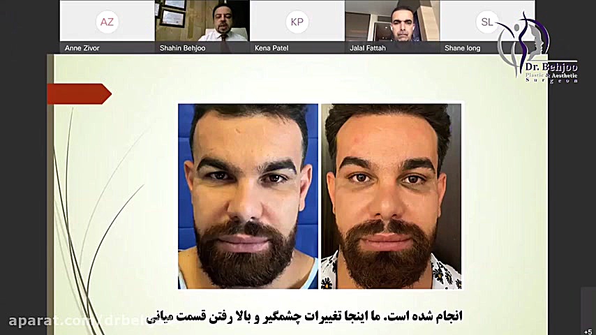 روشی نوین برای لیفت پیشانی و ابرو در وبینار لندن ۲۰۲۱ - 2 دکتر شاهین بهجو - فوق تخصص جراحی پلاستیک