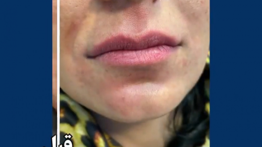 تزریق ژل لب دکتر امیر سلیمانی