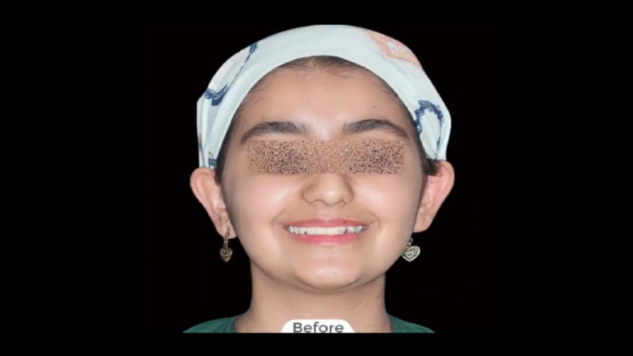 درمان ارتودنسی ثابت بدون کشیدن دندان دائمی دکتر برهمن سبزواری - متخصص ارتودنسی - مشهد