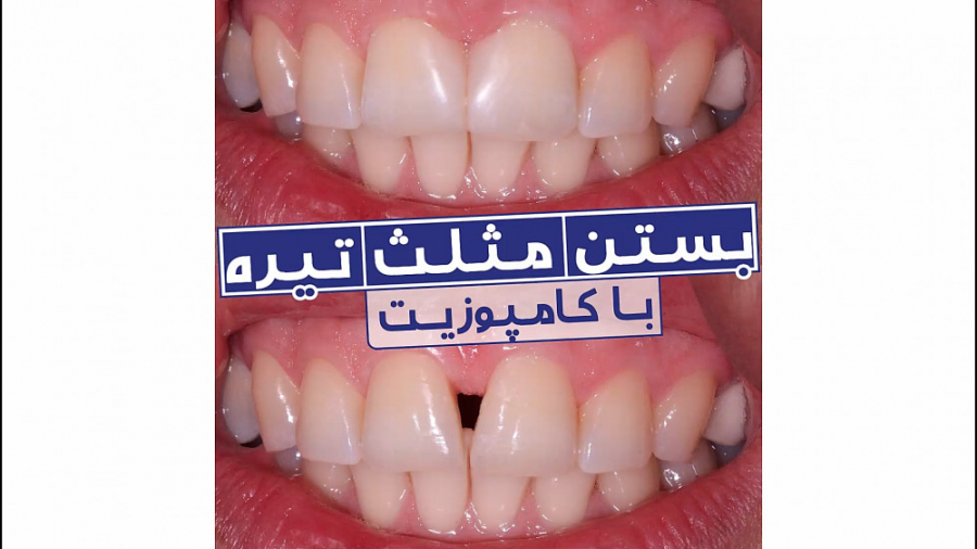 بستن فاصله دندان ها با کامپوزیت | کلینیک سیمادنت پزشکی زیرآب