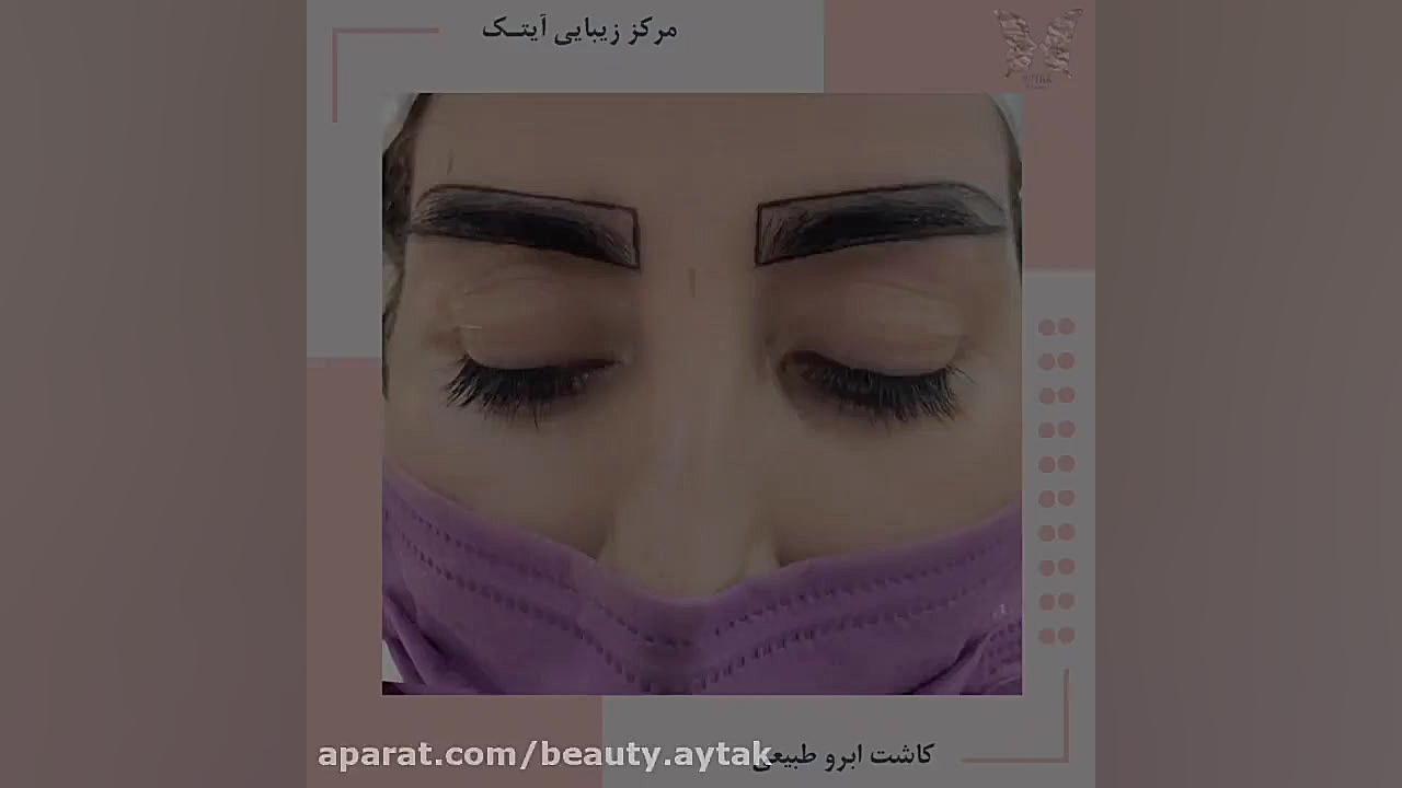 فیلم پیوند ابرو طبیعی | مرکز کاشت آیتک | آر اف فرکشنال