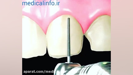 روکش کردن دندان تست دفع سدیم ادرار