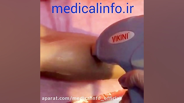 لیزر موهای زائد نقص اسیدهای چرب زنجیره متوسط