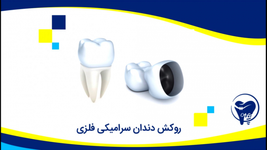 روکش دندان سرامیکی فلزی کلینیک دندانپزشکی دکتر عزیز گشاده رو