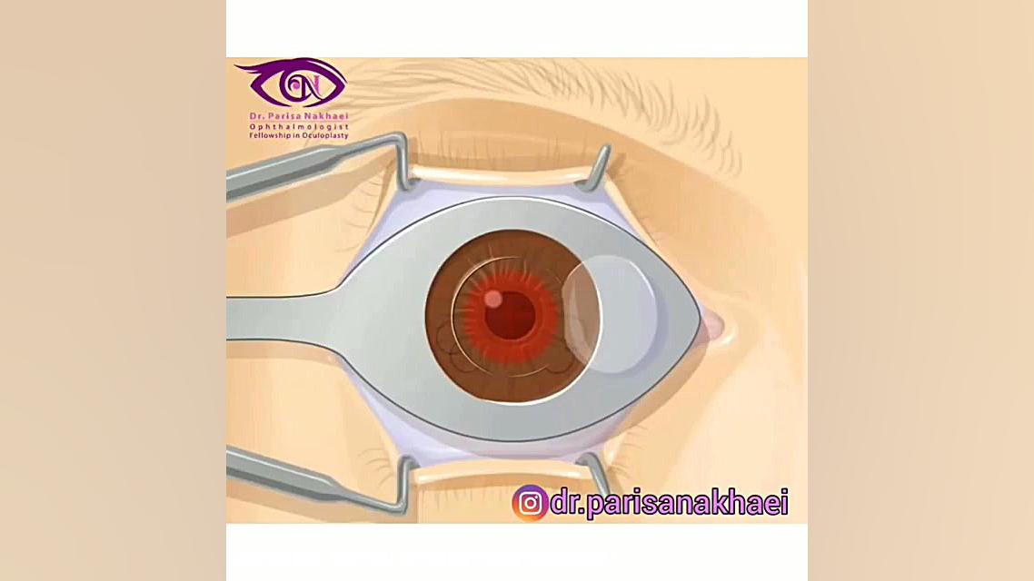 جراحی لیزیک چشم Apoptosis Pathway Analysis