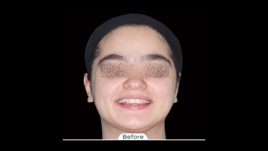 ارتودنسی ثابت دو فک باکشیدن دو دندان آسیای کوچک در فک بالا دکتر برهمن سبزواری - متخصص ارتودنسی - مشهد