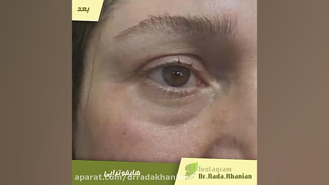 هایفو تراپی جهت رفع چین و چروک و شل شدگی پوست پزشکی زیرآب