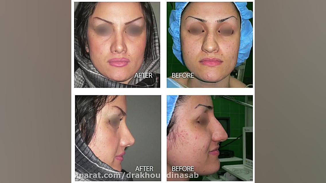 جراحی بینی گوشتی با اصلاح انحراف بینی دکتر محمدرضا آخوندی نسب-فوق تخصص جراحی پلاستیک