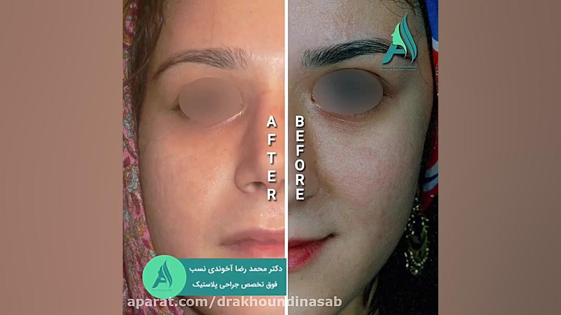 جراحی بینی طبیعی دکتر محمدرضا آخوندی نسب-فوق تخصص جراحی پلاستیک