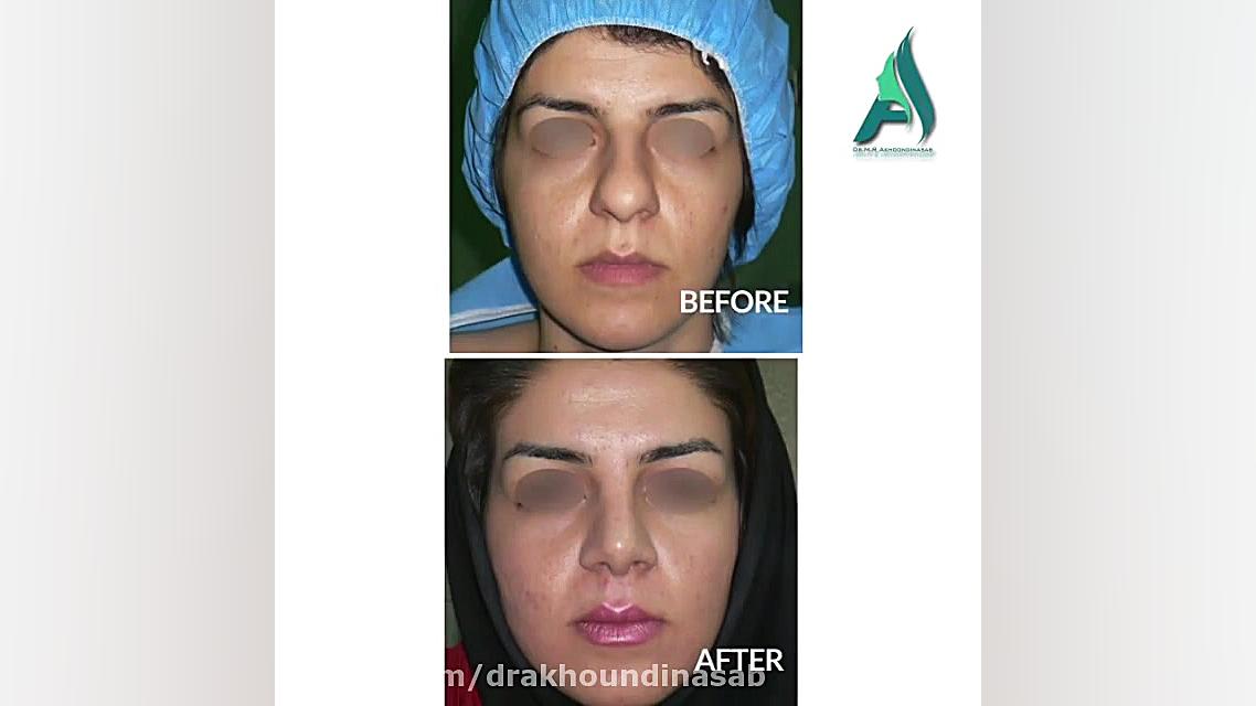 جراحی زیبایی بینی گوشتی دکتر محمدرضا آخوندی نسب-فوق تخصص جراحی پلاستیک