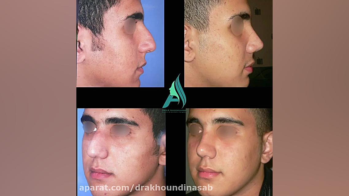 جراحی بینی مردانه دکتر محمدرضا آخوندی نسب-فوق تخصص جراحی پلاستیک