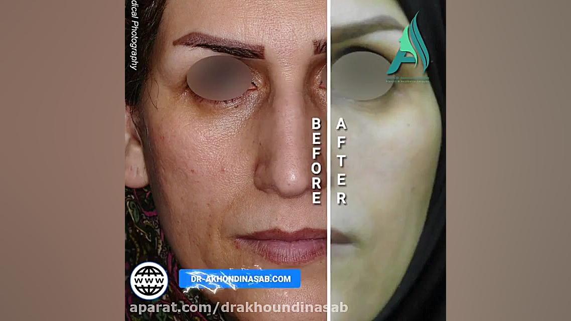 جراحی طبیعی بینی دکتر محمدرضا آخوندی نسب-فوق تخصص جراحی پلاستیک