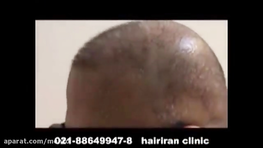 کاشت مو و لیزر بلیچینگ دندان