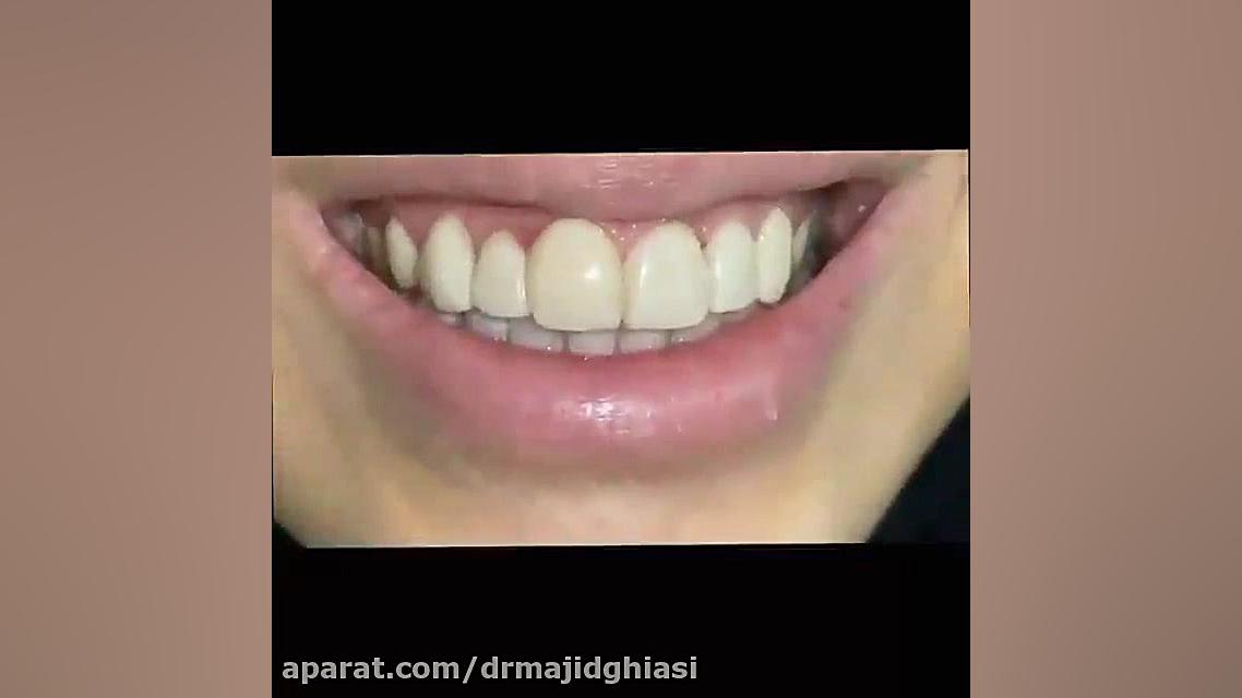اصلاح طرح لبخند پیلینگ شیمیایی