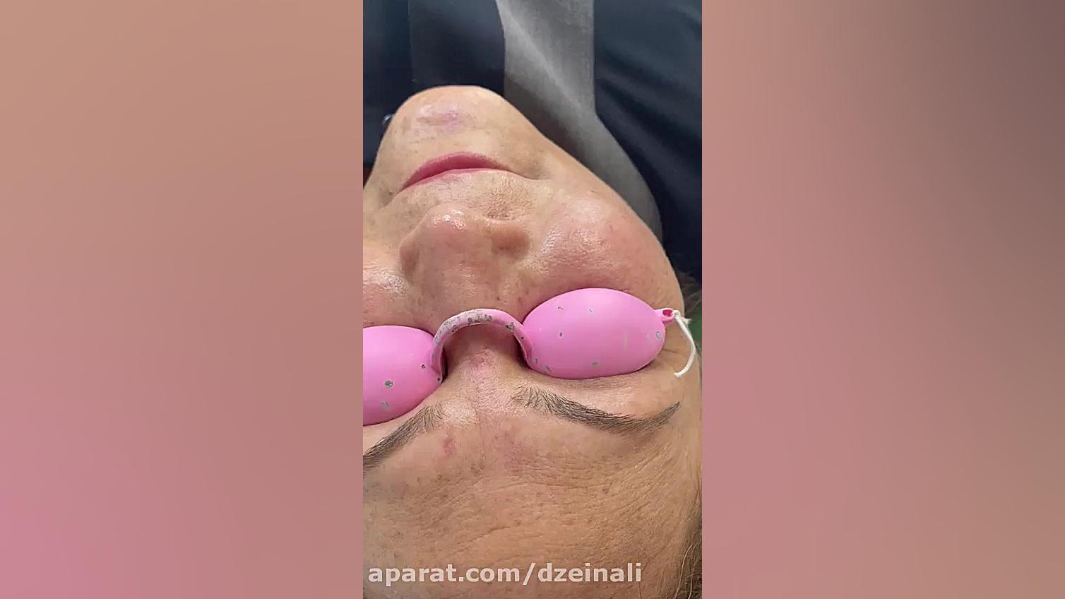 بهبود عالی خال های صورت با لیزر و جراحی بدون باقی ماندن اسکار دکتر فرحناز زینعلی - متخصص پوست، مو، زیبایی زنجان