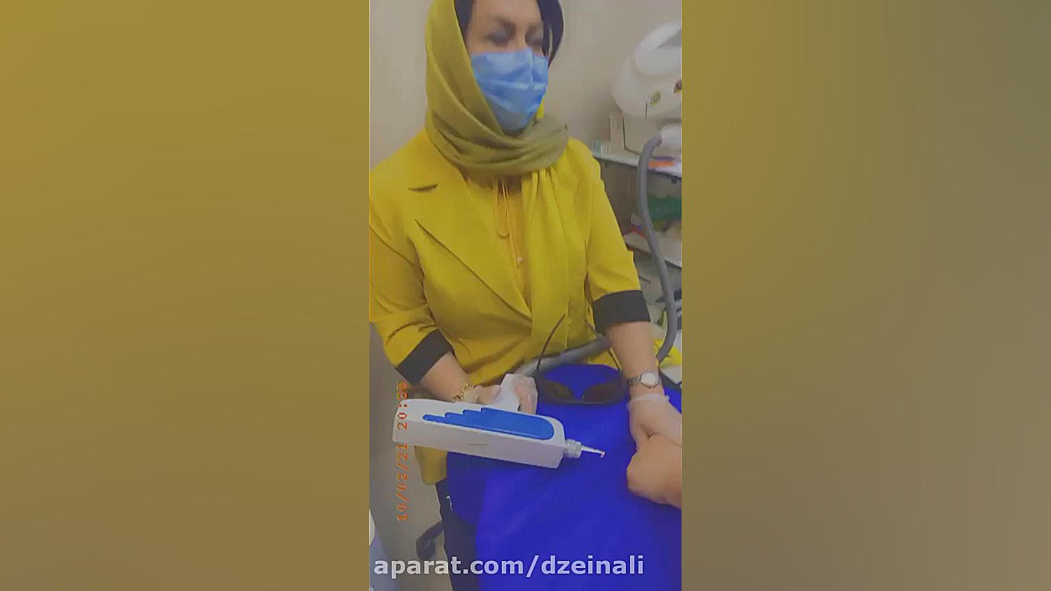 درمان لک های پشت دست با لیزر دکتر فرحناز زینعلی - متخصص پوست، مو، زیبایی زنجان