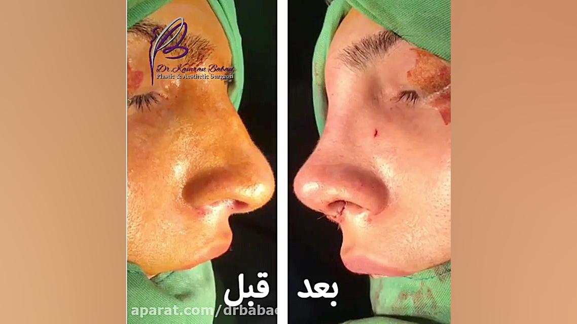 تقارن سازی با جراحی بینی دکتر کامران بابایی