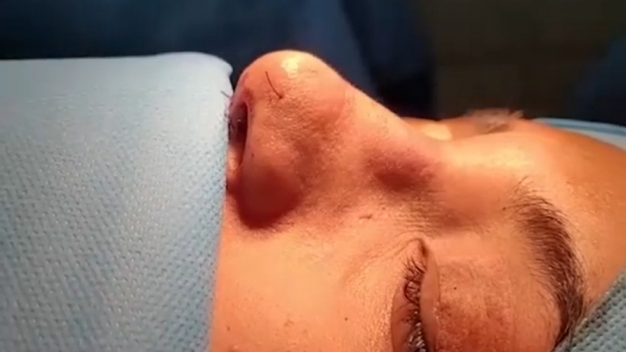 فیلم واقعی و بدون سانسور جراحی زیبایی بینی دکتر کامران بابایی