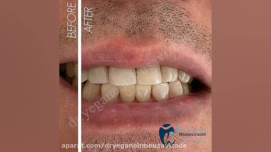 اصلاح طرح لبخند سنداکتیلی