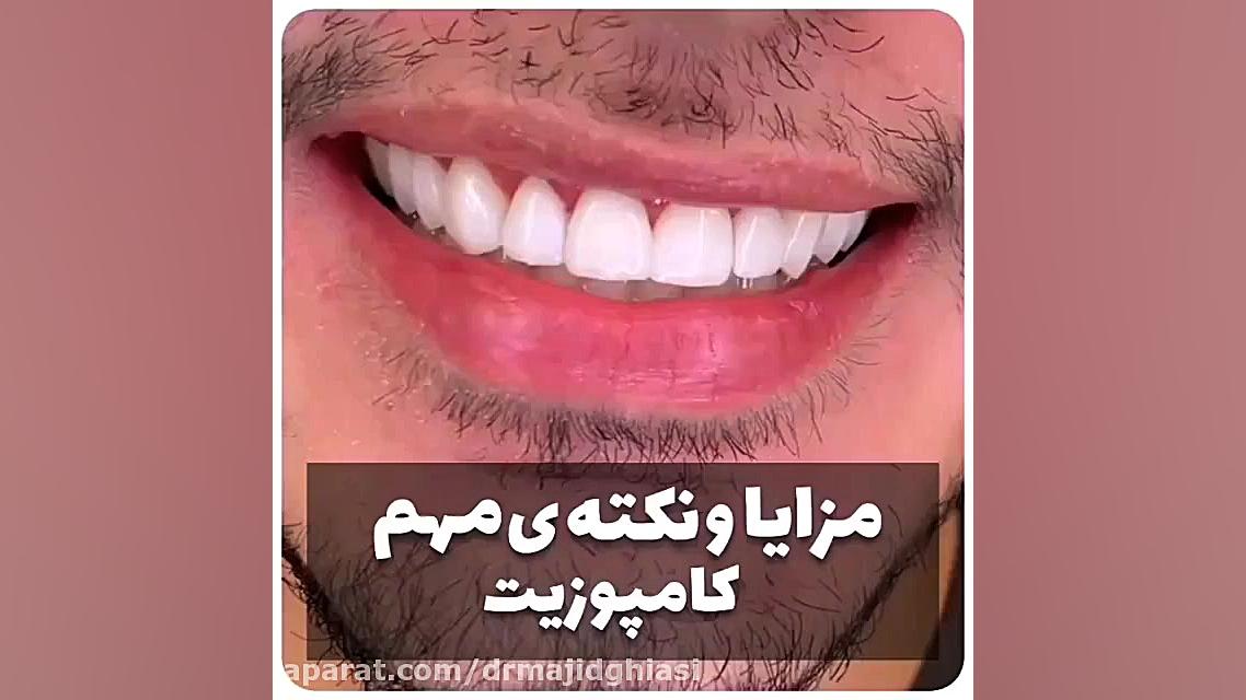 مزایای کامپوزیت ونیر دکترمجیدقیاسی