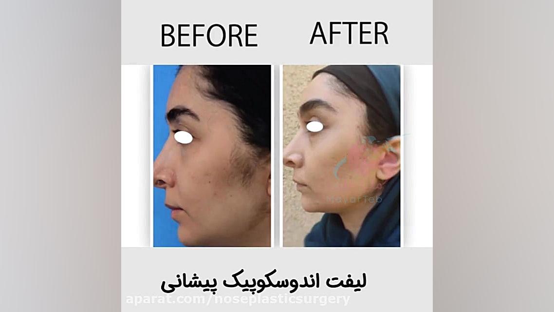 لیفت اندوسکوپیک پیشانی RNA Interference Assay