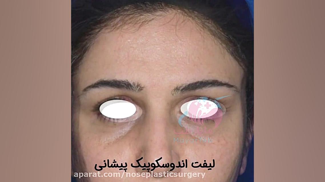 نمونه کار لیفت اندوسکوپیک پیشانی تست تنفس اوره C13