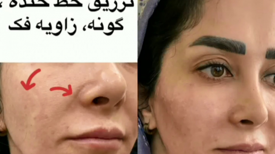 فیلم تزریق ژل خنده، گونه و زاویه فک دکتر حمیده آقایی