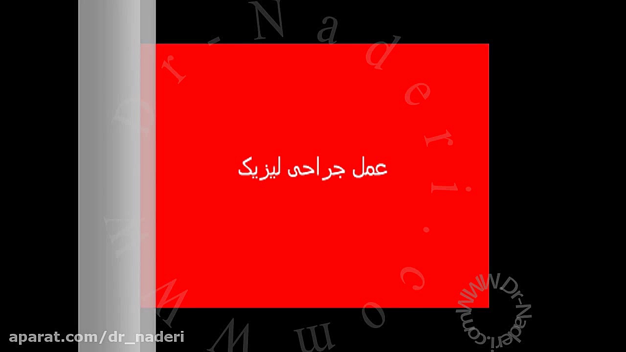 عمل جراحی لیزیک - مرکز چشم پزشکی دکتر علیرضا نادری مرکز چشم پزشکی دکتر علیرضا نادری www.dr-naderi.com