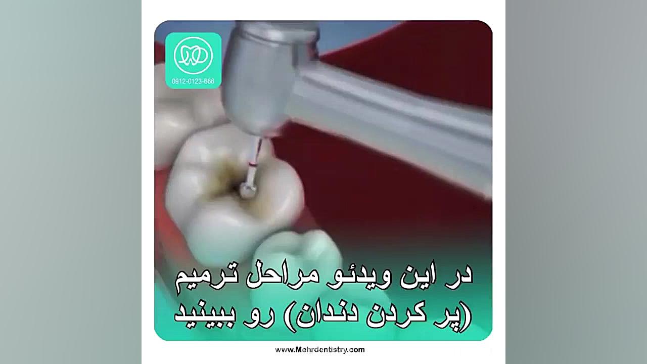 ترمیم دندان (پرکردن ) زوترلینیب