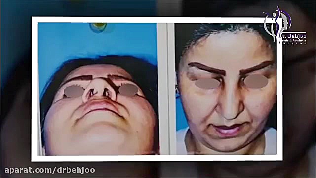 فیلم واقعی جراحی انحراف بینی دکتر شاهین بهجو - فوق تخصص جراحی پلاستیک