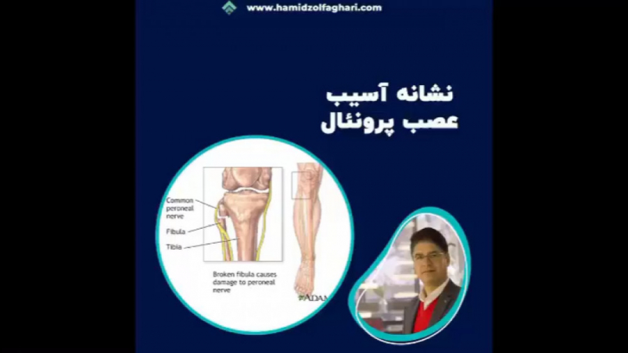 نشانه آسیب عصب پرونئال فرزاد فرزین