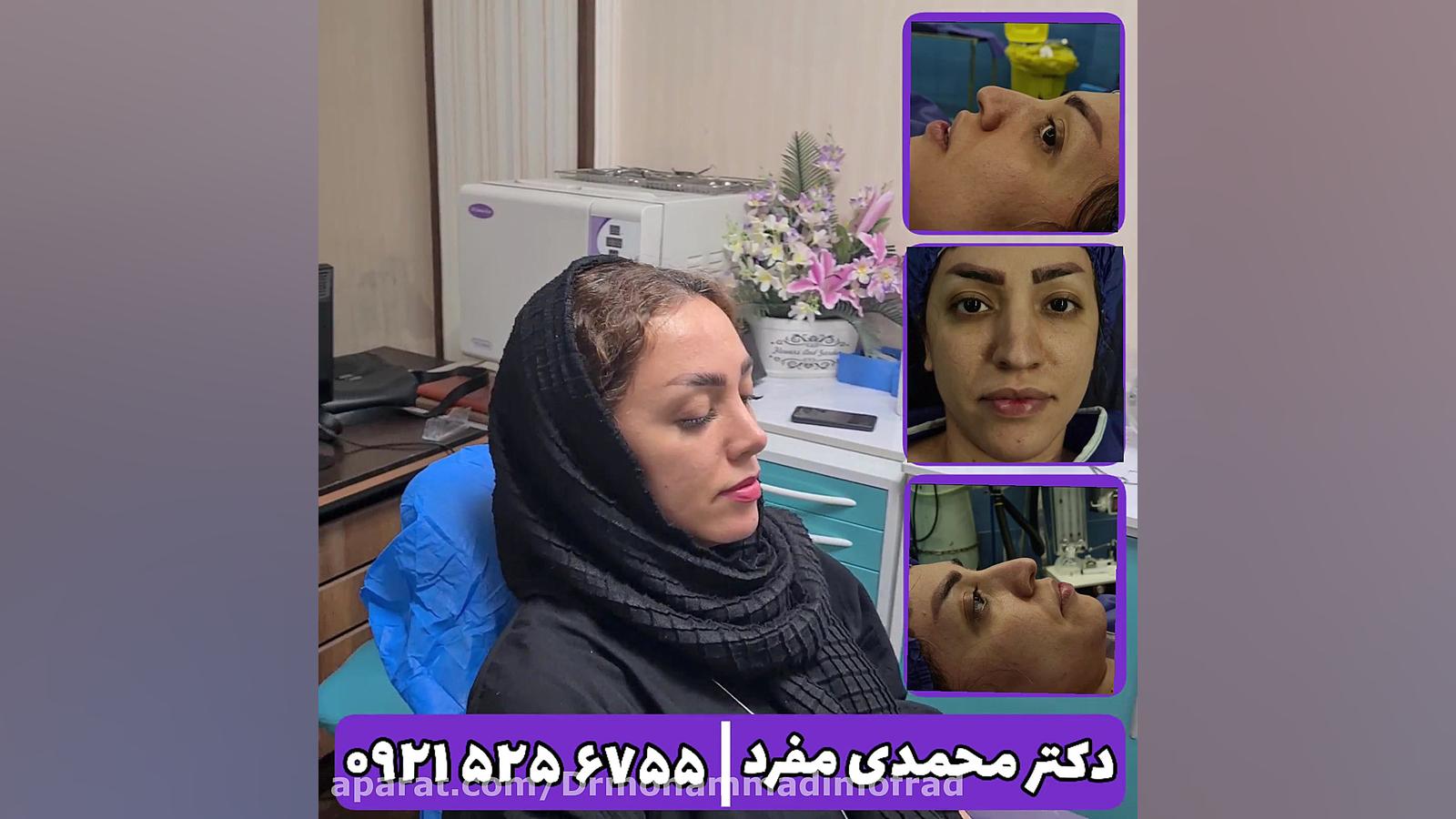 عمل زیبایی بینی ، دکتر امیر حسین محمدی مفرد دکتر امیر حسین محمدی مفرد