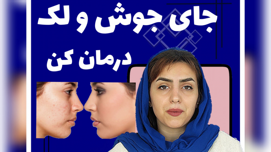 درمان لک و جای جوش صورت دندانپزشک زیبایی