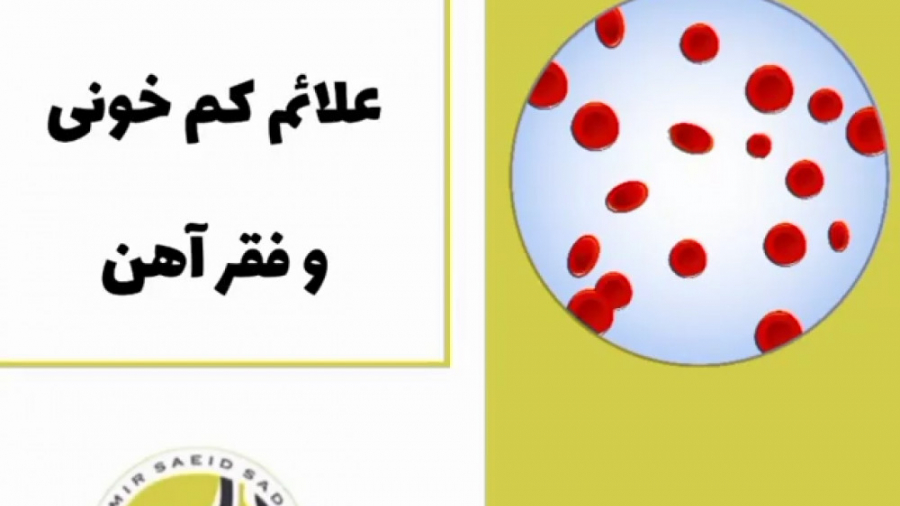 علائم کم خونی و فقر آهن دکتر امیر سعید صادقی (فوق تخصص گوارش و کبد)