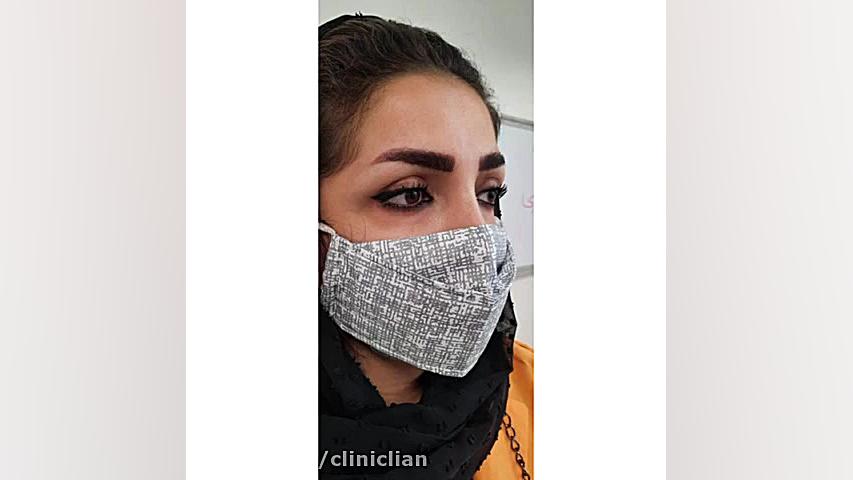 کاشت ابرو 1 ( مرکز تخصصی کاشت مو / ابرو لیان ) ماموپلاستی