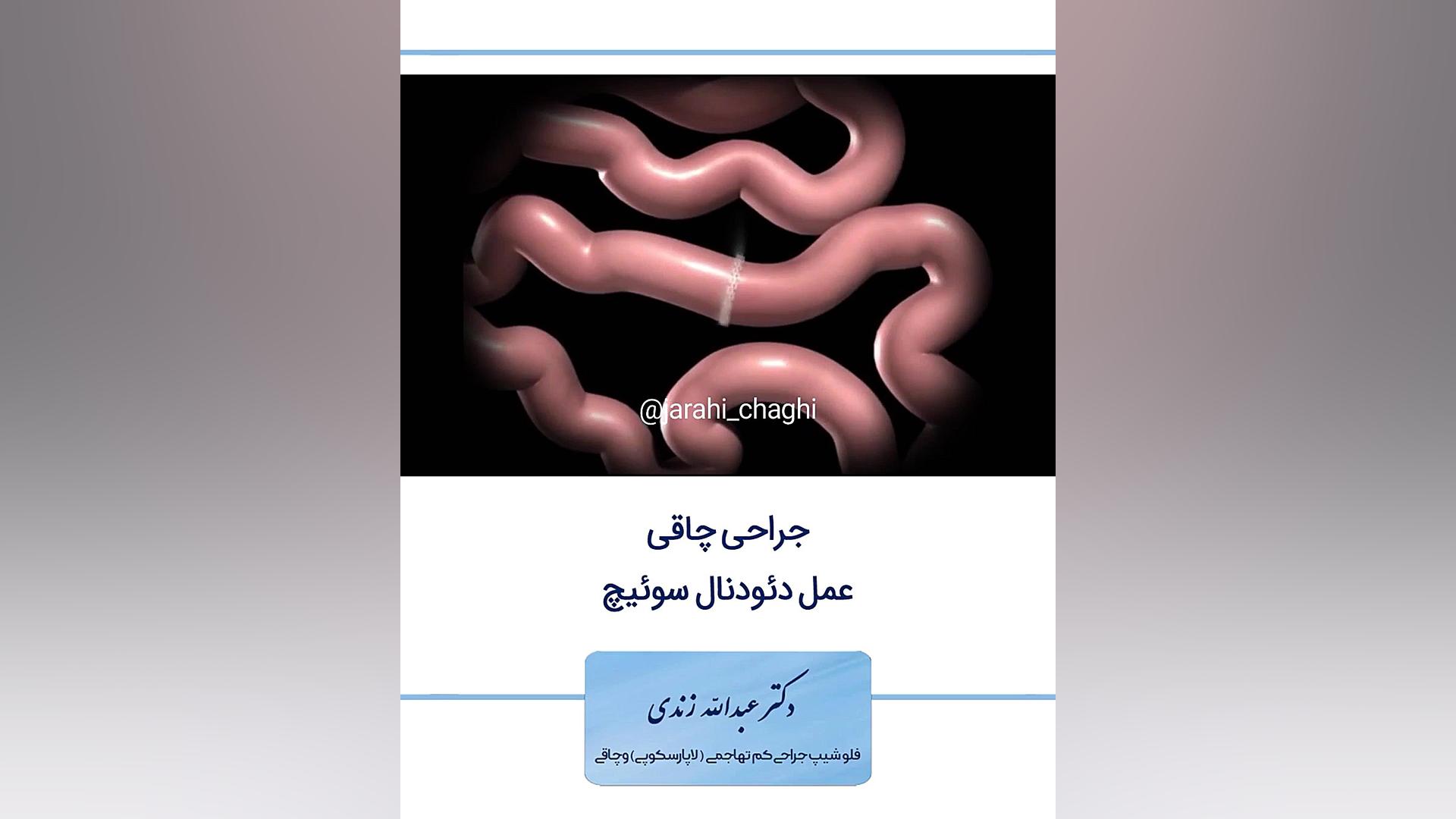 جراحی چاقی عمل دئودنال سوئیچ انسریدا