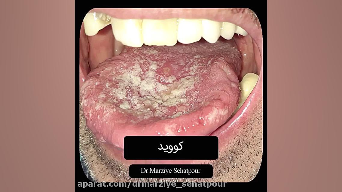 علائم دهانی کرونا (دکتر مرضیه صحت پور)drmarziyesehatpour