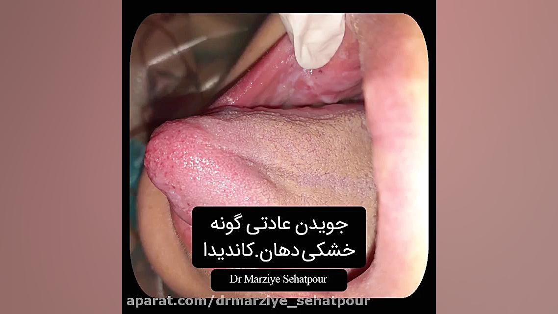 جویدن عادتی گونه (دکتر مرضیه صحت پور)drmarziyesehatpour