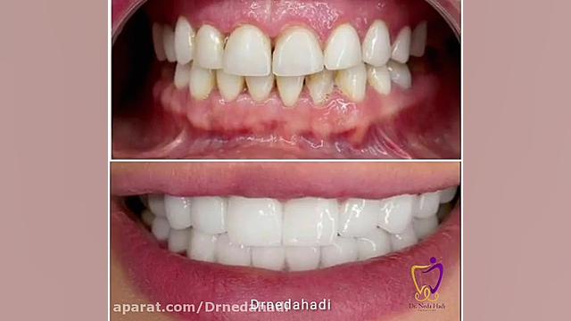 نتیجه برداشت کامپوزیت دندان و انجام بیست واحد لمینت دکتر ندا هادی-دندانپزشک زیبایی
