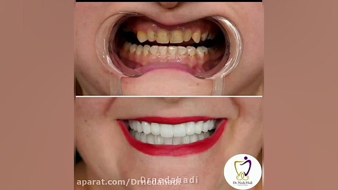فیلم واقعی از درمان ترکیبی ایمپلنت و لمینت برای زیباجوی عزیز دکتر ندا هادی-دندانپزشک زیبایی