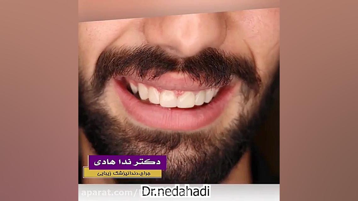 رضایت زیباجوی عزیز از نتیجه شگفت انگیز کامپوزیت دندان دکتر ندا هادی-دندانپزشک زیبایی