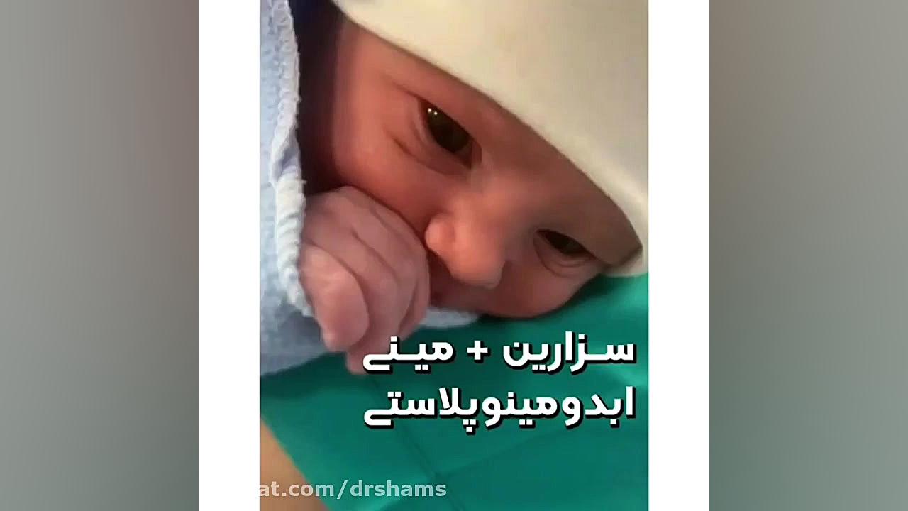 فیلم واقعی سزارین و مینی ابدومینوپلاستی در اتاق عمل جراحی پف زیر چشم