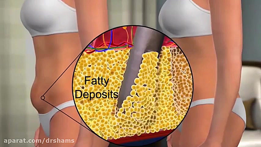 حقایقی در مورد ابدومینوپلاستی همزمان با سزارین دکتر شیرین شمس جراح و متخصص زنان و زایمان