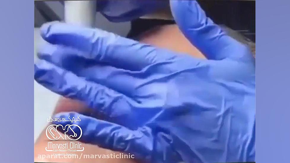 میکرونیدلینگ و جوانسازی پوست لیزر موهای زائد