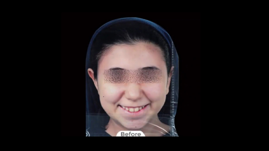 درمان ارتودنسی فکین با کشیدن ۴ دندان آسیای کوچک دائمی در دو فک دکتر برهمن سبزواری - متخصص ارتودنسی - مشهد